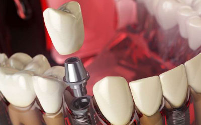 Photo of Этапы протезирования зубов: с чего начать?