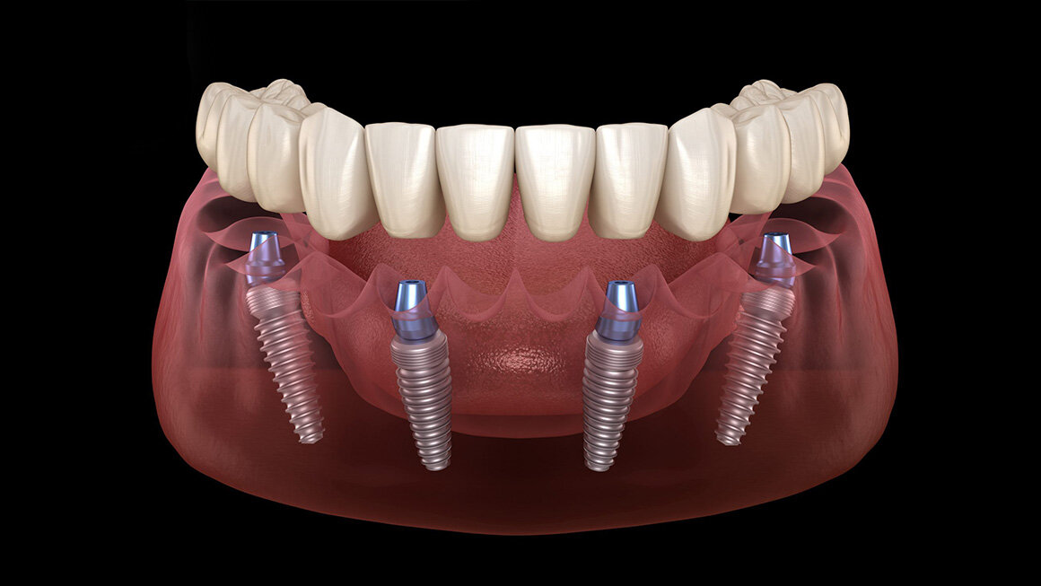 Зубные импланты какие клиники